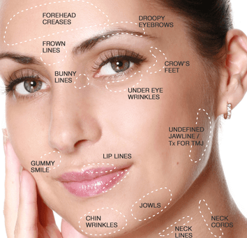 botox north london treatment areas