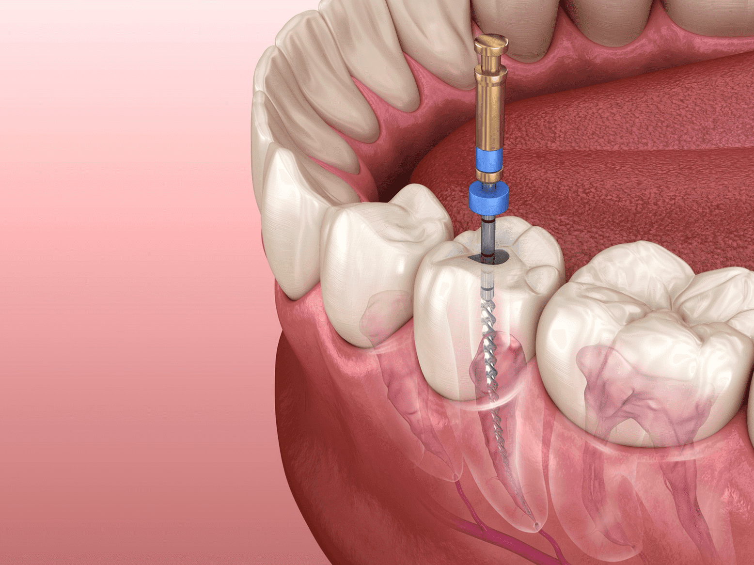 Root canal treatment golders green north london